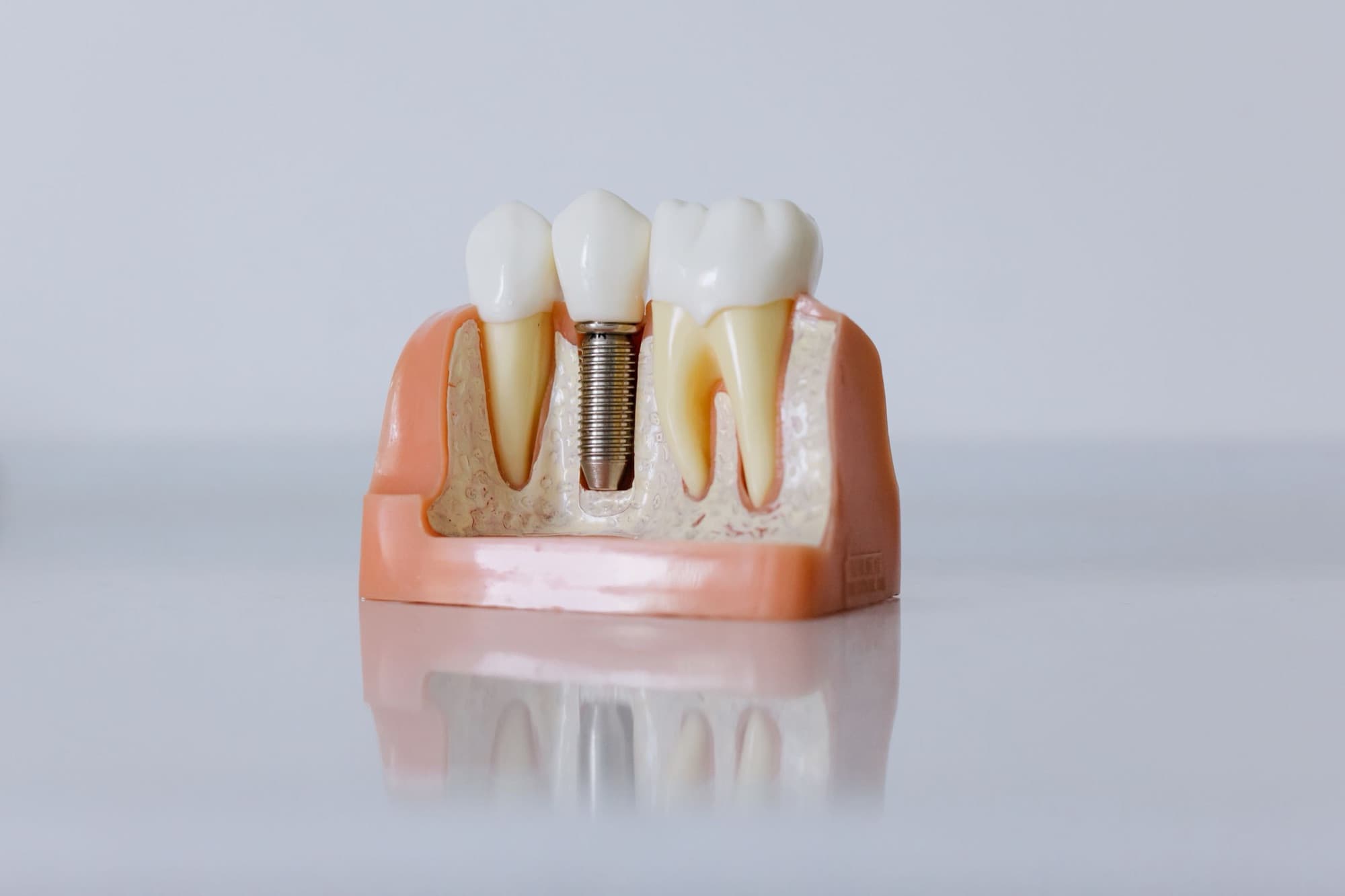 Implant